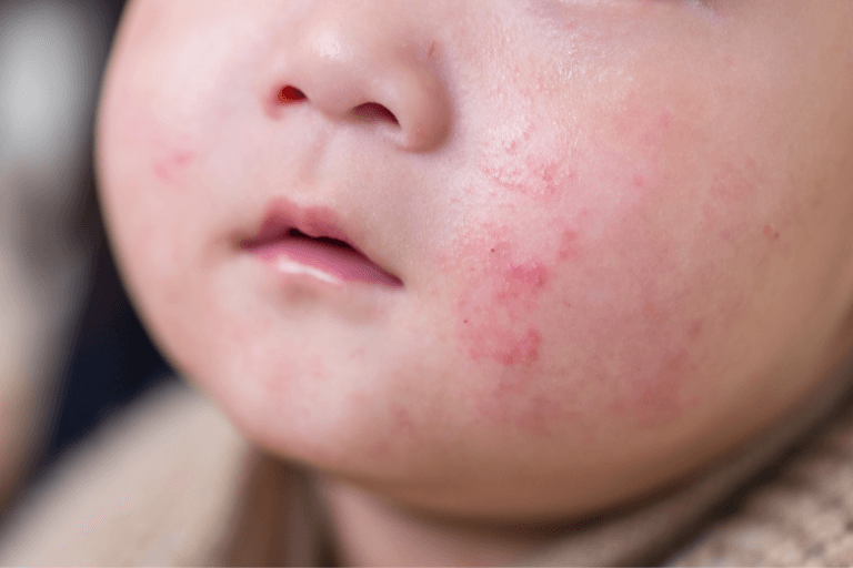 Pediatric Eczema: Triggers and Management in UAE Climate