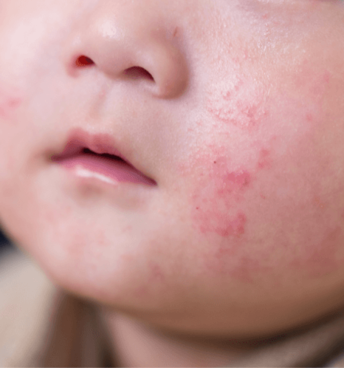 Pediatric Eczema: Triggers and Management in the UAE Climate